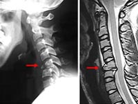 柳田ｱﾅが生放送中に頚椎骨折で全身麻痺に・・・