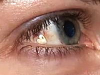 マジキチ。ファッションで眼球にプラチナを埋め込む女性がいるらしい。手術動画。