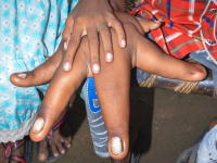 インドの奇病。両手が異常に大きくなってしまった8歳の男の子のビデオ。巨人症？