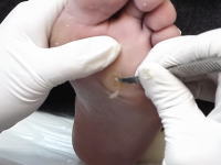 スッキリ動画。プロによる魚の目除去のビデオが気持ちいいと話題になっている動画。